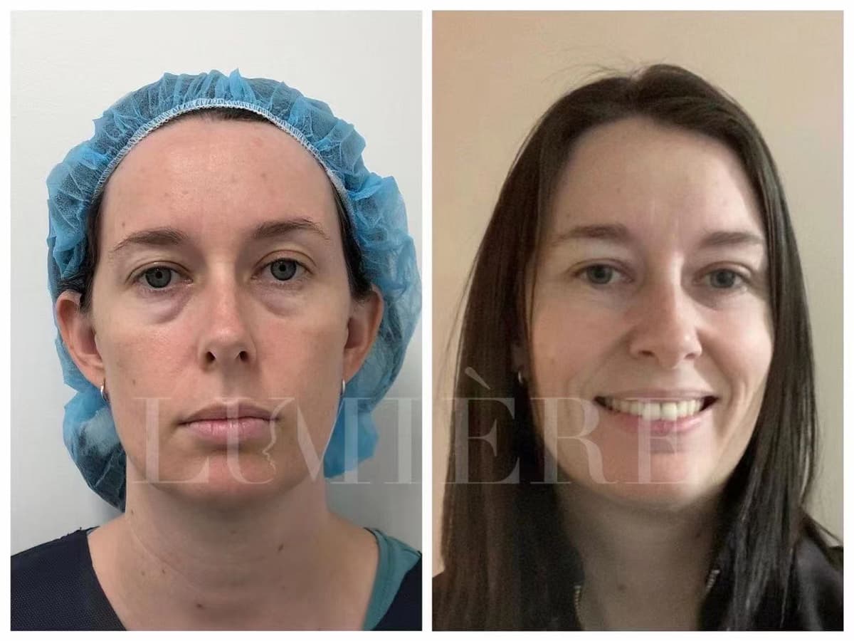 Eye bag removal result - case 1